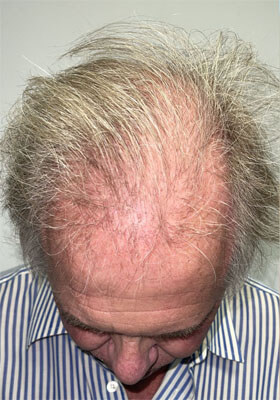 hair transplant photos