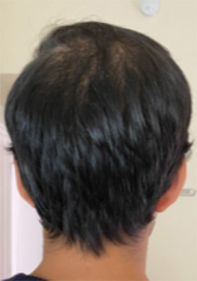 hair transplant before after Photos