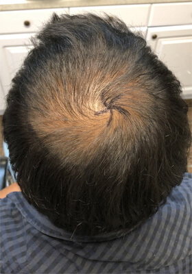 hair transplant before after Photos