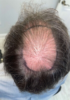 hair transplant before after Photos