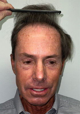 hair transplant photos