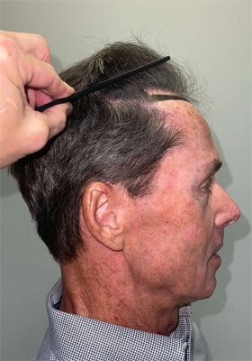 hair transplant photos