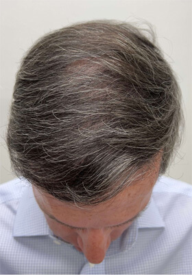 hair transplant photos