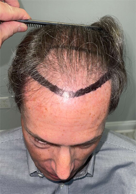 hair transplant photos