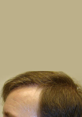 hair transplant photos