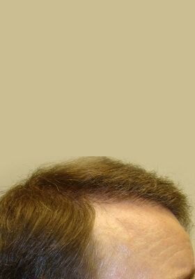 hair transplant before after Photos