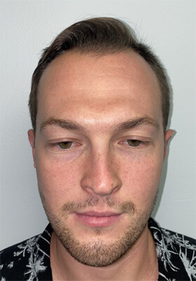 hair transplant photos