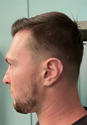 hair transplant photos