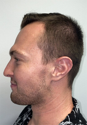 hair transplant photos