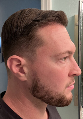 hair transplant photos