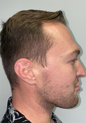 hair transplant photos