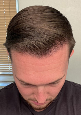 hair transplant before after Photos