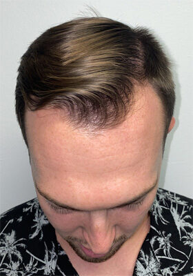 hair transplant before after Photos