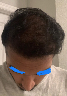 hair transplant before after Photos