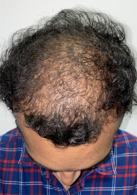 hair transplant photos