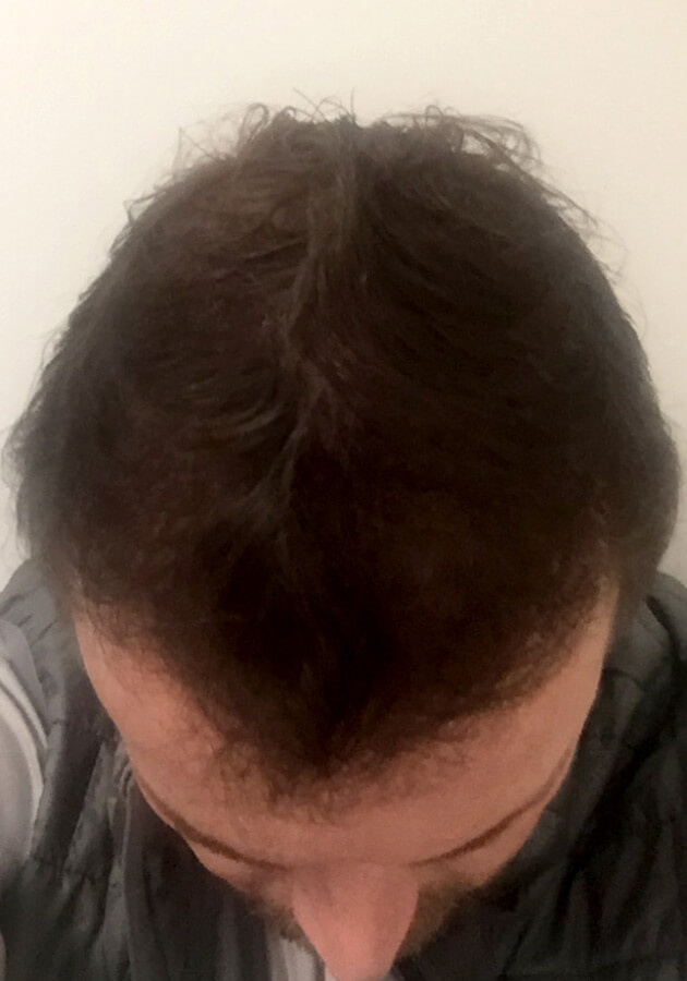 hair transplant photos