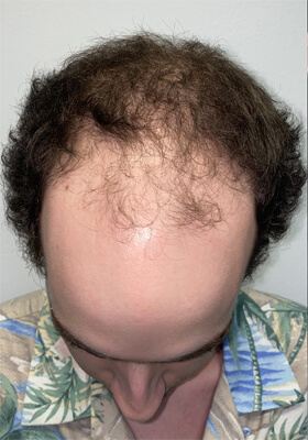 hair transplant photos