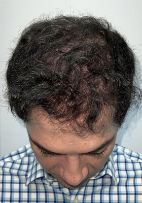 hair transplant photos