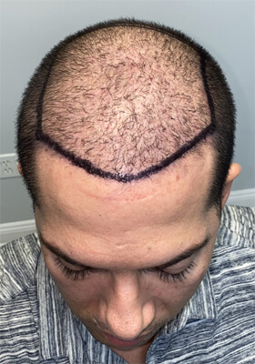 hair transplant before after Photos