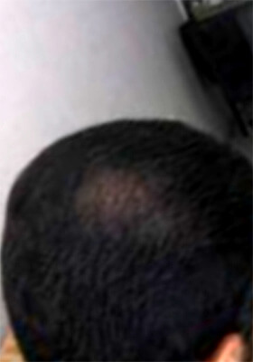 hair transplant before after Photos