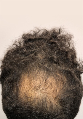 hair transplant photos