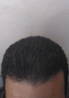 hair transplant photos