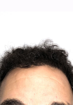 hair transplant photos