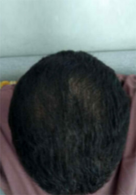 hair transplant photos