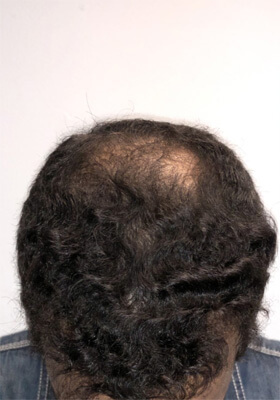 hair transplant photos