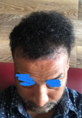 hair transplant photos