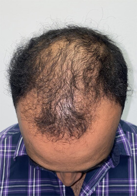 hair transplant before after Photos