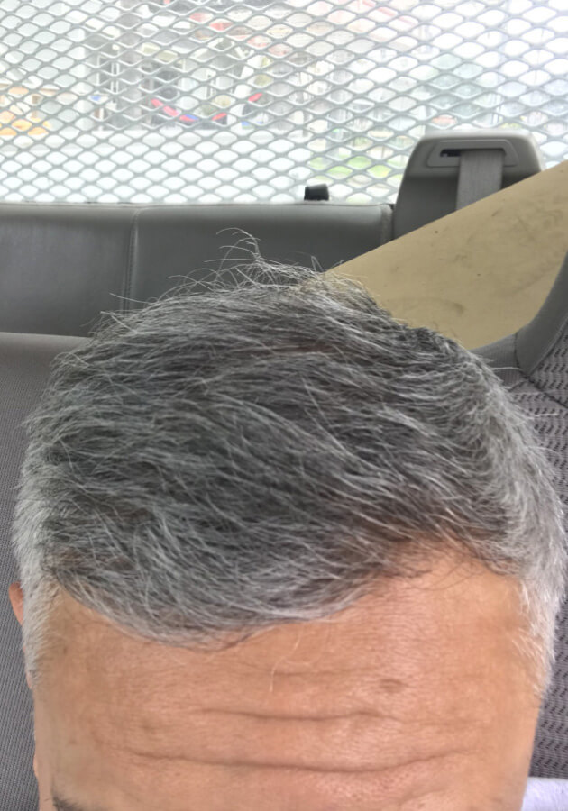 hair transplant before after Photos