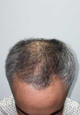 hair transplant before after Photos