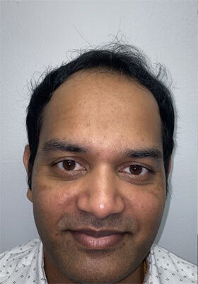 hair transplant before after Photos