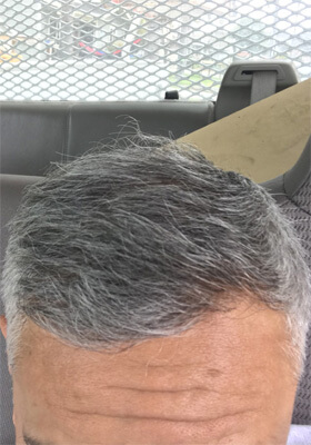 hair transplant photos