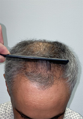 hair transplant before after Photos