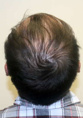 hair transplant photos