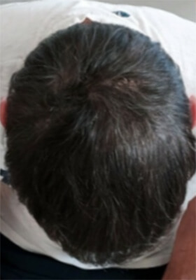 hair transplant before after Photos