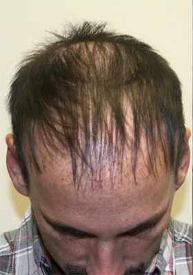 hair transplant before after Photos