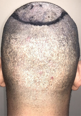 hair transplant photos