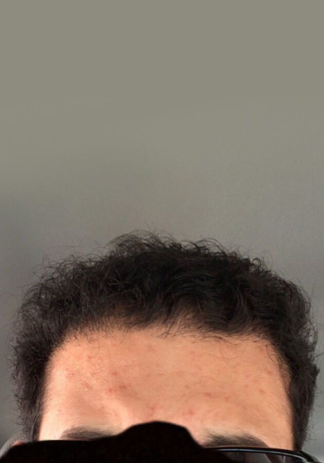 hair transplant photos