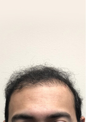 hair transplant before after Photos