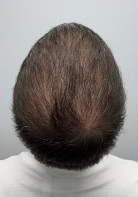 hair transplant photos