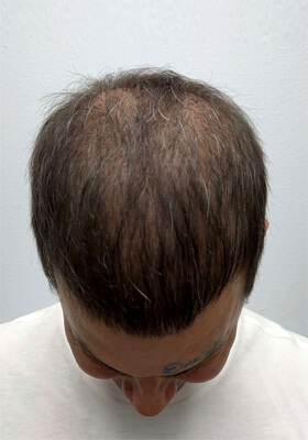 hair transplant photos