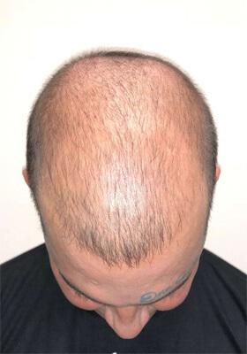 hair transplant photos