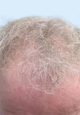 hair transplant photos