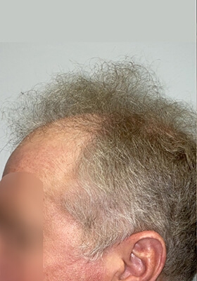 hair transplant photos