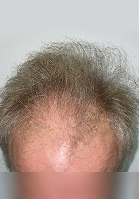 hair transplant photos