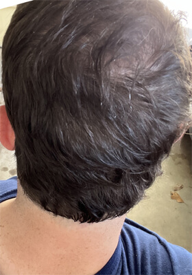 hair transplant before after Photos