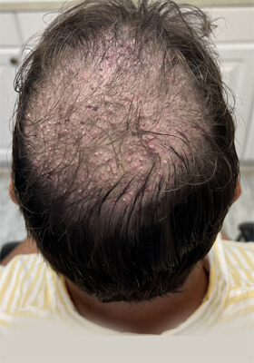 hair transplant photos